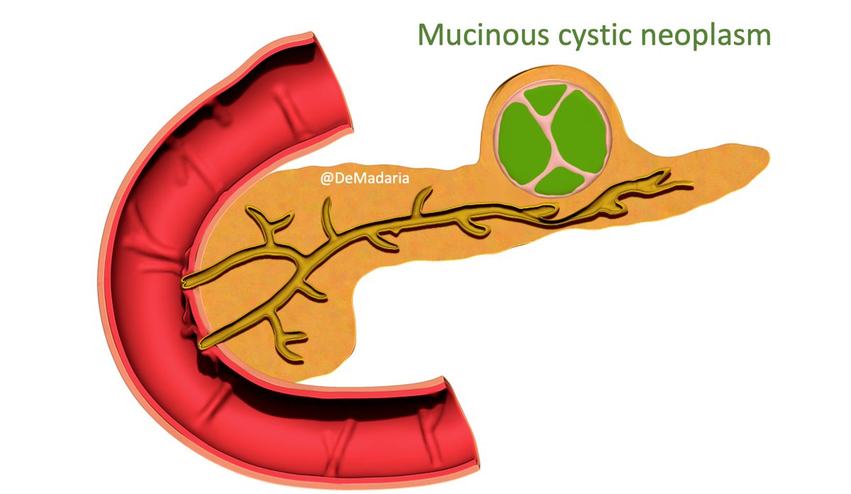 What is > accurate to predict that a cystic pancreatic lesion is mucinous or not, intra-cystic CEA or glucose?Look at this meta-analysis from Sandra Faias et al  @GIE_Journal-follow the twitter thread @ChahalPrabhleen  @japariciot2  @Belenmm271  @lelecapurso  @guspereztweets