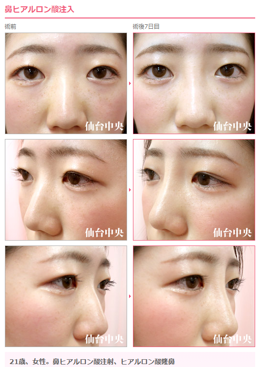 仙台中央クリニック美容整形美容外科 鼻が低い ために ヒアルロン酸注射 による 隆鼻 を行いました 鼻ヒアルロン酸注射が横に広がる リスクがあり 目と目の間が膨らんでいる と 鼻ヒアルロン酸注射 をしたことバレバレです 鼻整形 鼻筋を通す 鼻