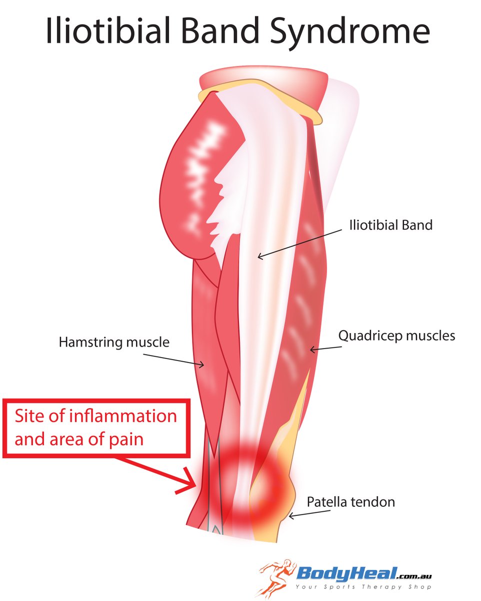 ITB SyndromeThe outside of your thigh has a thick band of fascia called the Iliotibial Band. A lot of people foam roll this structure, but it has no contractile tissue, so doing this achieves nothing. Common symptoms: - Outer knee pain- Tight outer quads / hamstrings