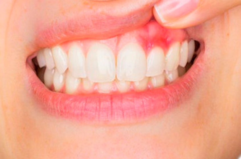 BoomersAssistan's tweet photo. https://t.co/9Phft8jgjd
After analysis of several studies over and over again, doctors found that people with #gum #disease or tooth loss have an increased chance of suffering from cardiovascular problems. https://t.co/DnKdesjFOu