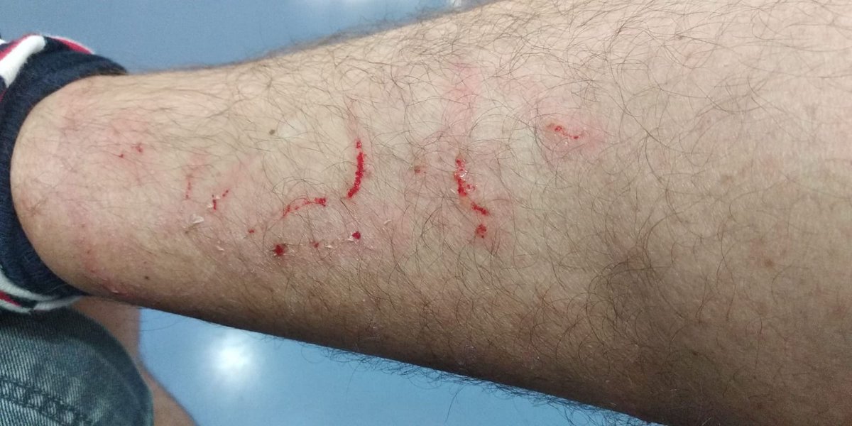 32Masnou's tweet photo. Esta mañana tenemos juicio,uno de muchos pendientes. Así dejó la pierna a un vecino sin venir a cuento: salió de su casa,le vio en las escaleras y se lanzó a agredirle. #justicia https://t.co/G828wiXQXx