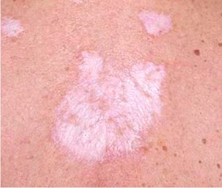 Apart from the bad odor and discomfort trapped sweat causes, your butt cracks can irritate the skin and make it a breeding ground for bacteria and fungi leading to infections such as painful boils, intertrigo (a form of rash), ringworm, candida.