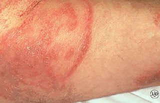 Other infections that can cause white patches in between your butts include: Shingles (especiallyif you had chicken pox as a child), Herpes (a STD), butt acne (yes, pimples).Other skin disorders include: Eczema, Psoriasis, Lichen Sclerosis (all to be explained later).