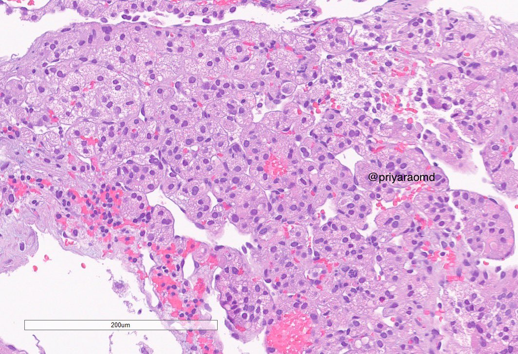 Name that kidney tumor in a 40 year old. Continued below with diagnostic stain. #GUpath