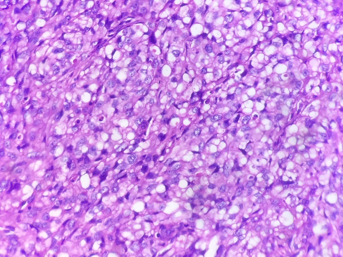 chidambharam's tweet photo. #dermatology #dermatopath @vi_monappa @padmapathology1. Need to see the entity,to know what the textbook description is. Cutaneous Angiosarcoma. Anastamosing vascular channels dissecting dermis, Fish in creek appearance. Atypical endothelial cells with abortive lumen and CD31+. https://t.co/TrQ37t3wCm