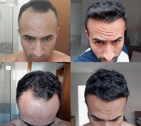 HairTransIST's tweet photo. Before &amp; After Hair Transplantation - 
Do you want to have your hairs to be restored?
Contact Us
#hairtransplant #hairtransplantinturkey #hairtransplantation #haircare #hairloss #hairtreatment #beforeafter #hairgrowth #transformations #trasplantecapilar #trasplantecapilarestambul https://t.co/LsIkqhOb2r