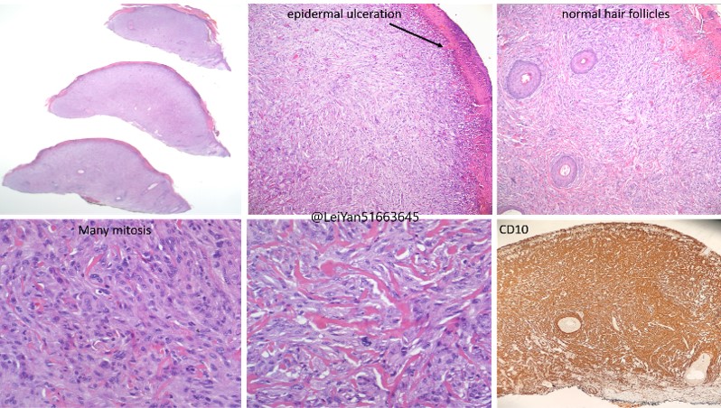 Texas Soc of Pathol (@texpathol) on Twitter photo Atypical fibroxanthoma in a 70 yo M w a friable red papule on the R earlobe.
-Essential to exclude other more specific diagnoses
-CD10+
-SMA, AE1/AE3, 34βE12, S100, SOX10-
#Cyto #GYNPath #BreastPath <a href="/LeiYan51663645/">Lei Yan, MD, PhD</a> Atypical fibroxanthoma in a 70 yo M w a friable red papule on the R earlobe.
-Essential to exclude other more specific diagnoses
-CD10+
-SMA, AE1/AE3, 34βE12, S100, SOX10-
#Cyto #GYNPath #BreastPath <a href="/LeiYan51663645/">Lei Yan, MD, PhD</a>