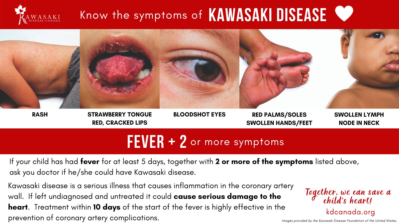Kawasaki Dis Canada on Twitter: #KawasakiDisease Day. Kawasaki Disease is the #1 cause of acquired heart disease in Canadian children. EARLY DETECTION IS CRITICAL, so know the symptoms! If