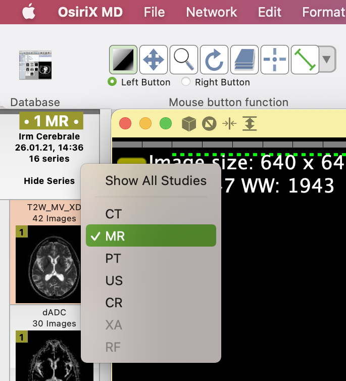 Did you know that you can limit the displayed modalities in the studies list in OsiriX MD 12? 🚀🤓

Right-click to choose the displayed modalities !

Demo movie:
osirix-viewer.net/LimitModalitie…

#OsiriXMD #efficiency #Workflow