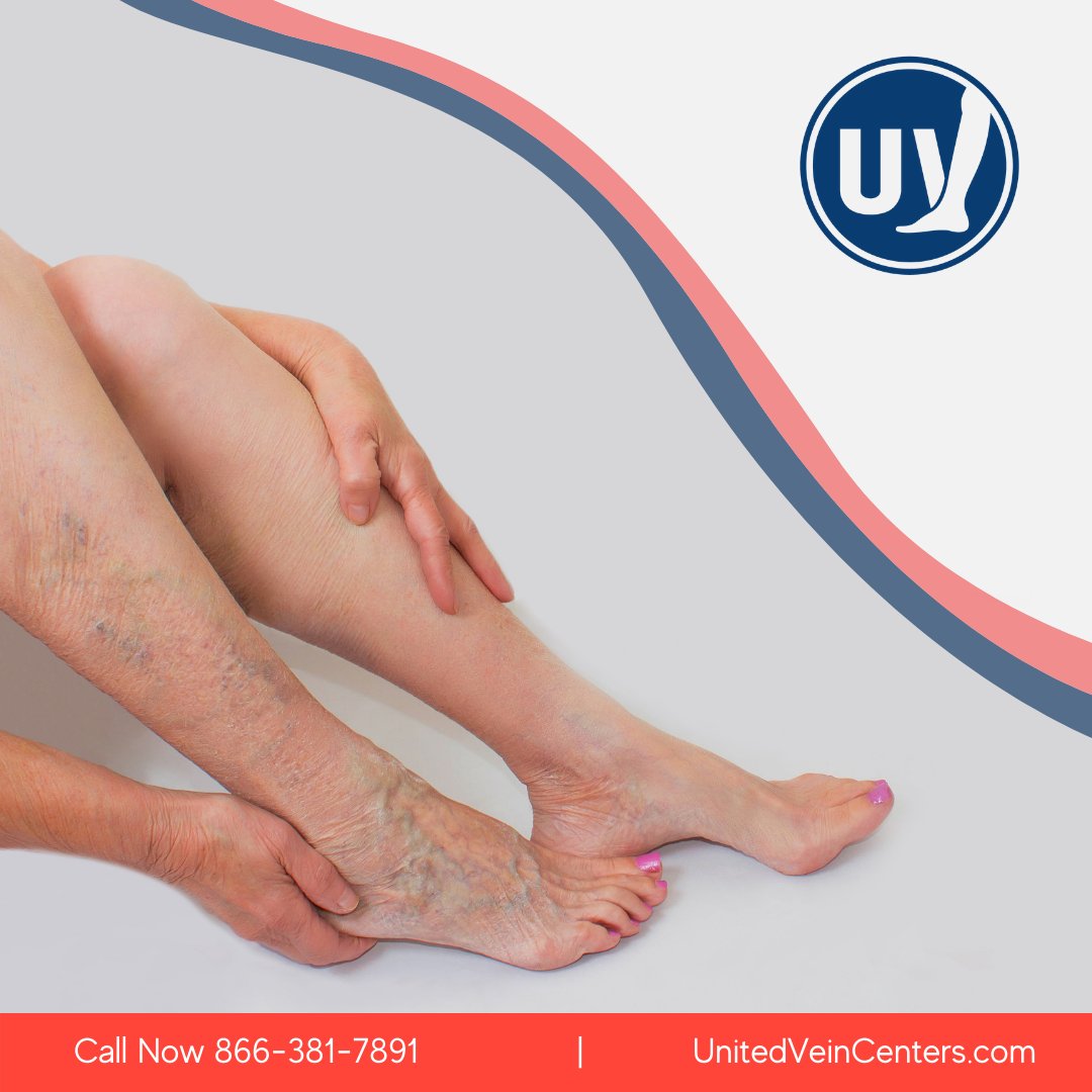 Symptoms of Chronic Venous Insufficiency may seem like other health conditions. Call United Vein Centers to schedule a free vein screening. 

📞 866-381-7891 bit.ly/2ISErC7 
#UnitedVeinCenters #VeinClinic #VeinDoctor #VaricoseVeinTreatment #VaricoseVeins