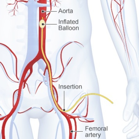 Congratulations to <a href="/winny_li/">Winny Li</a> on her editorial on #REBOA in this month's <a href="/CJEMonline/">CJEM</a> co-authored with <a href="/MarkusZiesmann/">Markus Ziesmann</a>  

REBOA in Canada: time to shine, or time’s up?
bit.ly/39kaSnt

&amp; paper it references (Gap analysis at Canadian trauma centre)
link.springer.com/article/10.100…