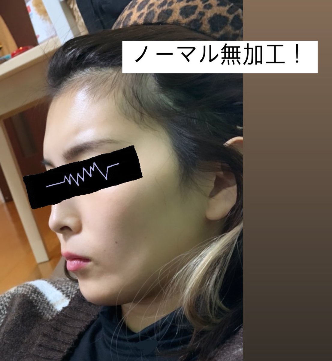 ヒロ On Twitter 矯正で7本も 歯科関係だけど親知らずも入ってる