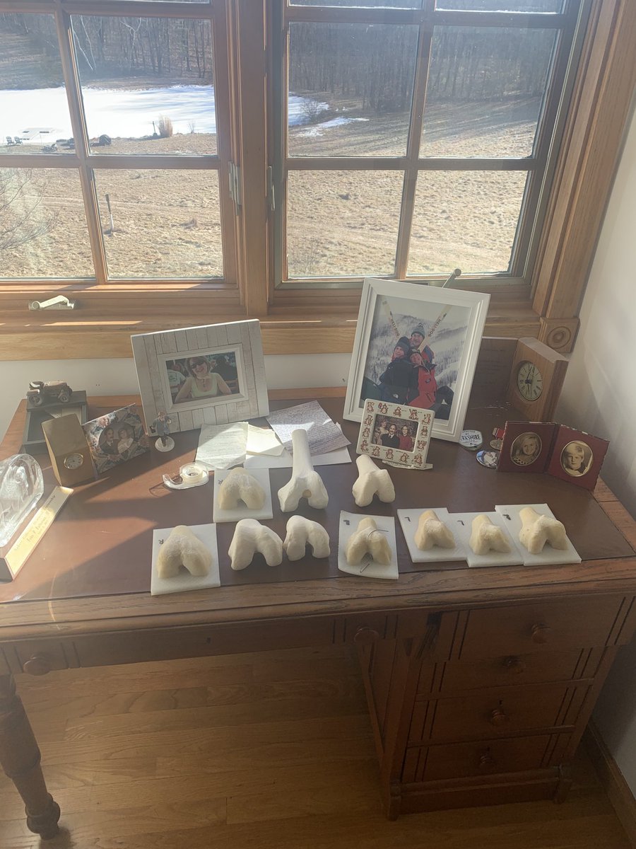 This is what happens to your desk when you’re trying to understand trochlea dysplasia.  No easy answers! Let’s just say that it’s not as simple as we have thought! 3D prints help a lot for difficult cases