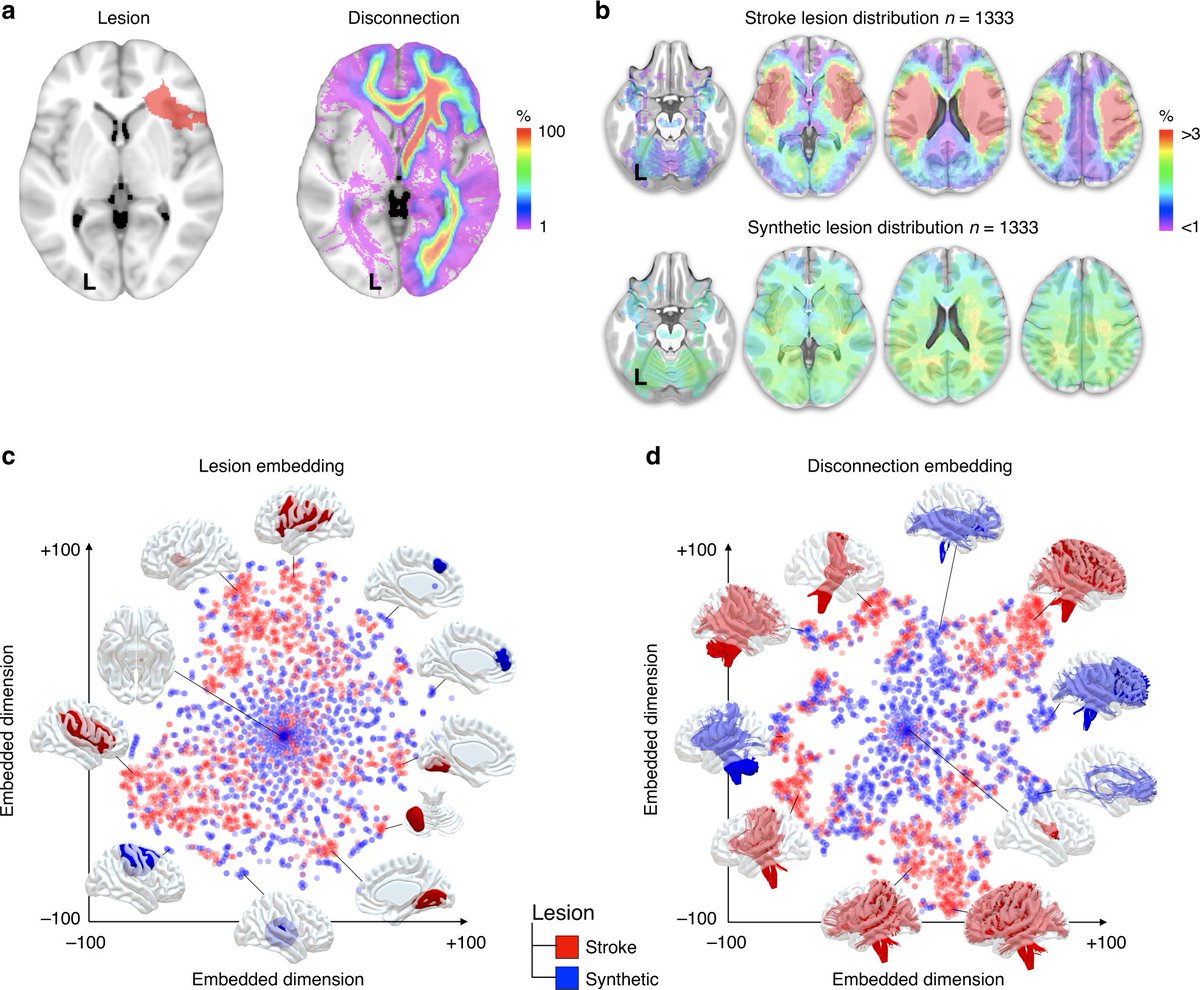 Check out Nature Communications highlights this month! Very pleased to see the disconnectome in there <a href="/FoulonChris/">Chris Foulon</a> <a href="/NatureComms/">Nature Communications</a> <a href="/ERC_Research/">European Research Council (ERC)</a> nature.com/collections/mj…