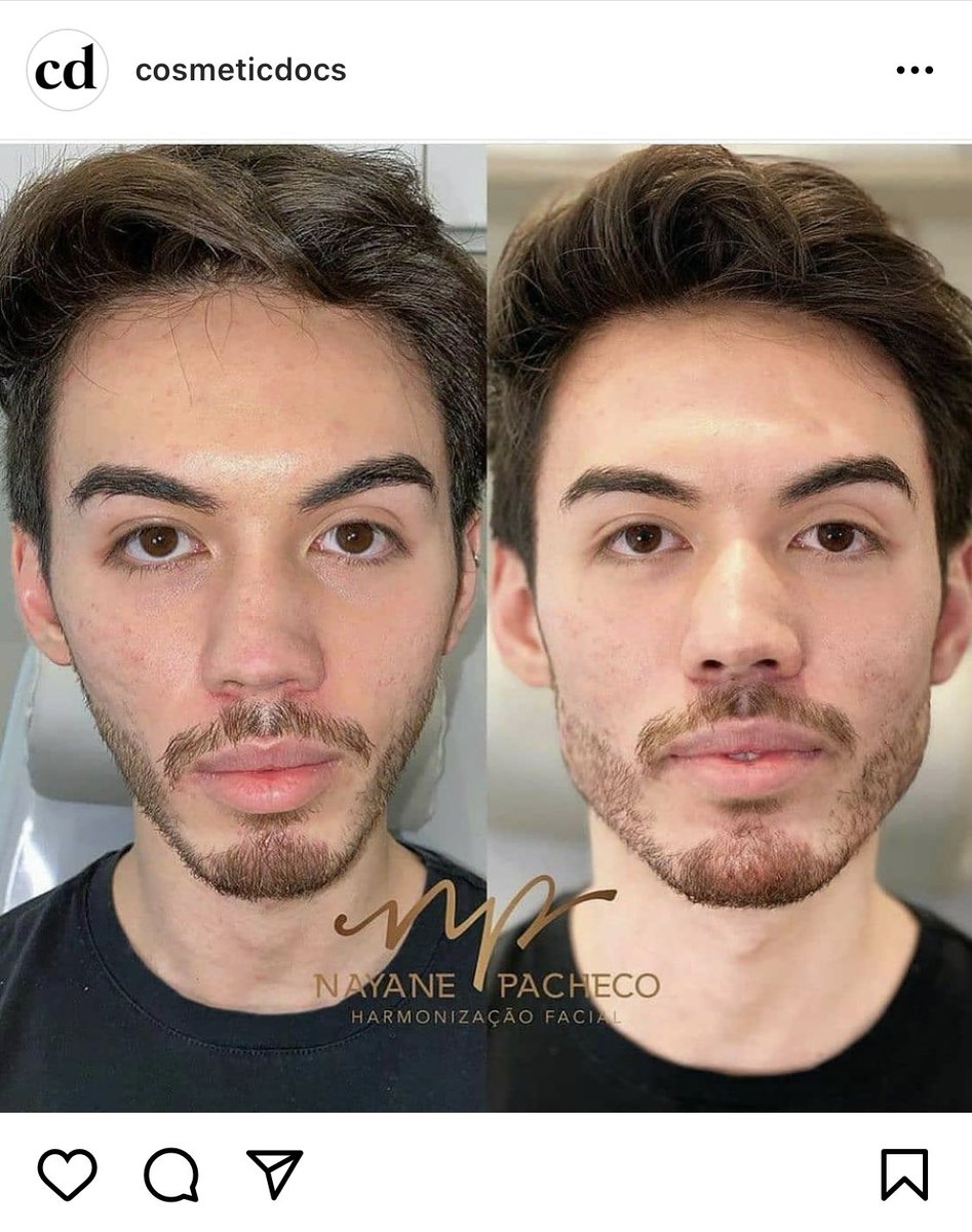 キリ子 エラとかあった方がいい場合もあるよねー 欧米の症例 変化すごくて見てて楽しい T Co 6j8vi1tjz6 Twitter