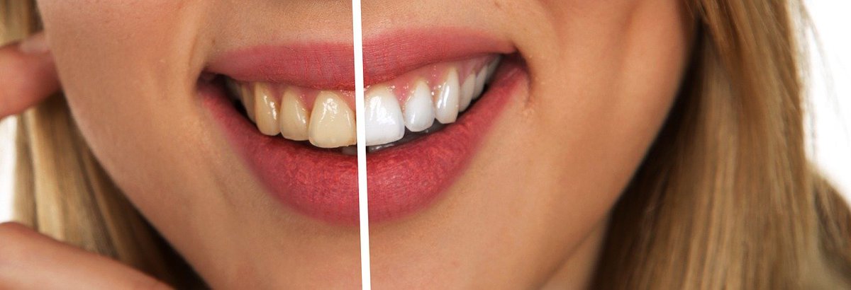 cassondentistry's tweet photo. A beautiful white smile can greatly boost your self-confidence. However, tobacco, wine, soft drinks, coffee, and tea can leave behind unwanted stains. We can help you restore the shine your teeth once had! https://t.co/2xD2y7DWXy https://t.co/IKZYTKt0In