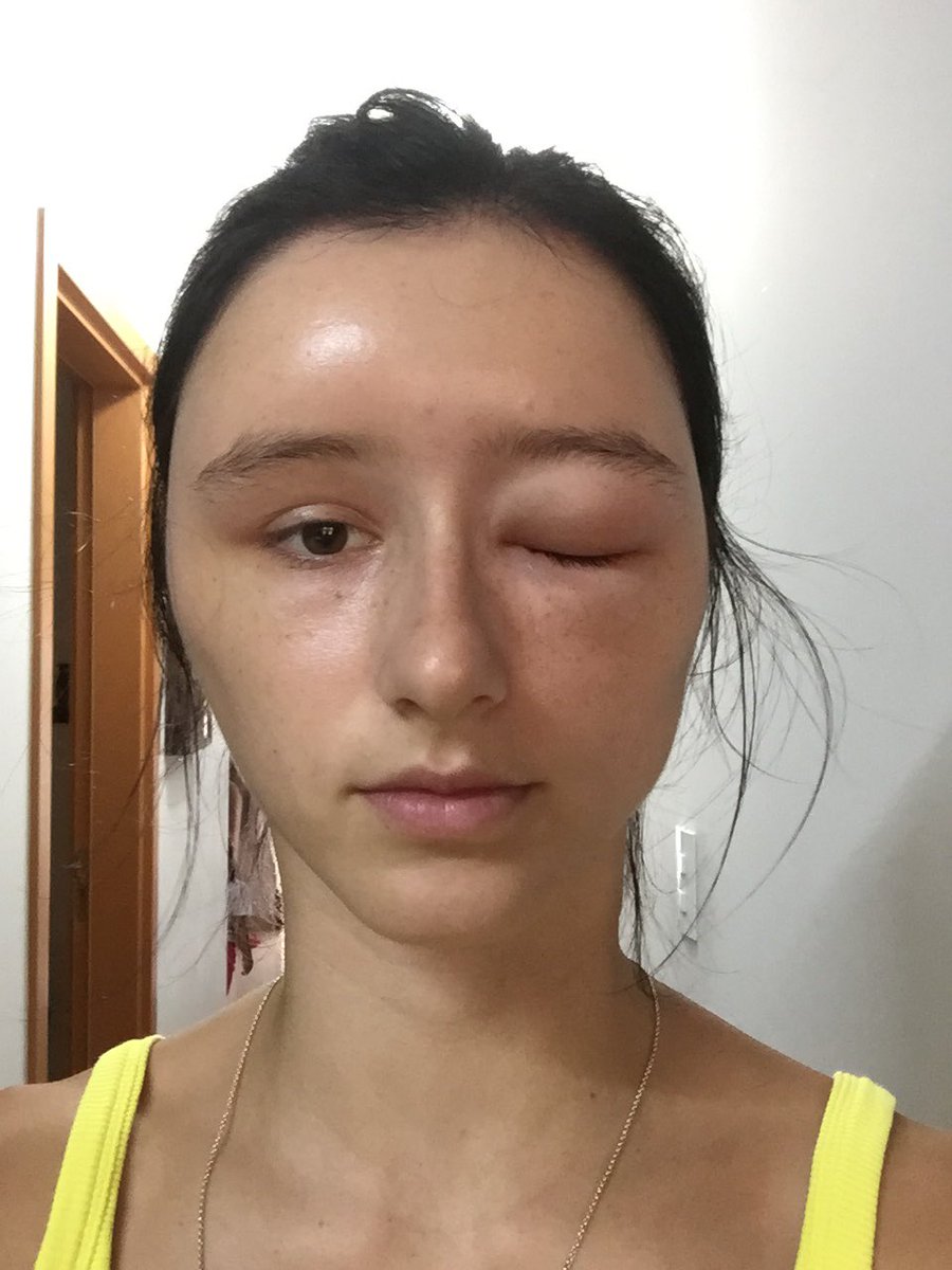 natykrausee's tweet photo. ALERTA TWEET CONSCIENTE

Antes da utilização de qualquer produto químico capilar façam um teste antes, galerinha!

Descobri de forma tardia e não tão agradável - por falta de discernimento sobre - a importância de fazer o teste com a tinta antes e descobri uma forte alergia. https://t.co/4jLjaVeg63