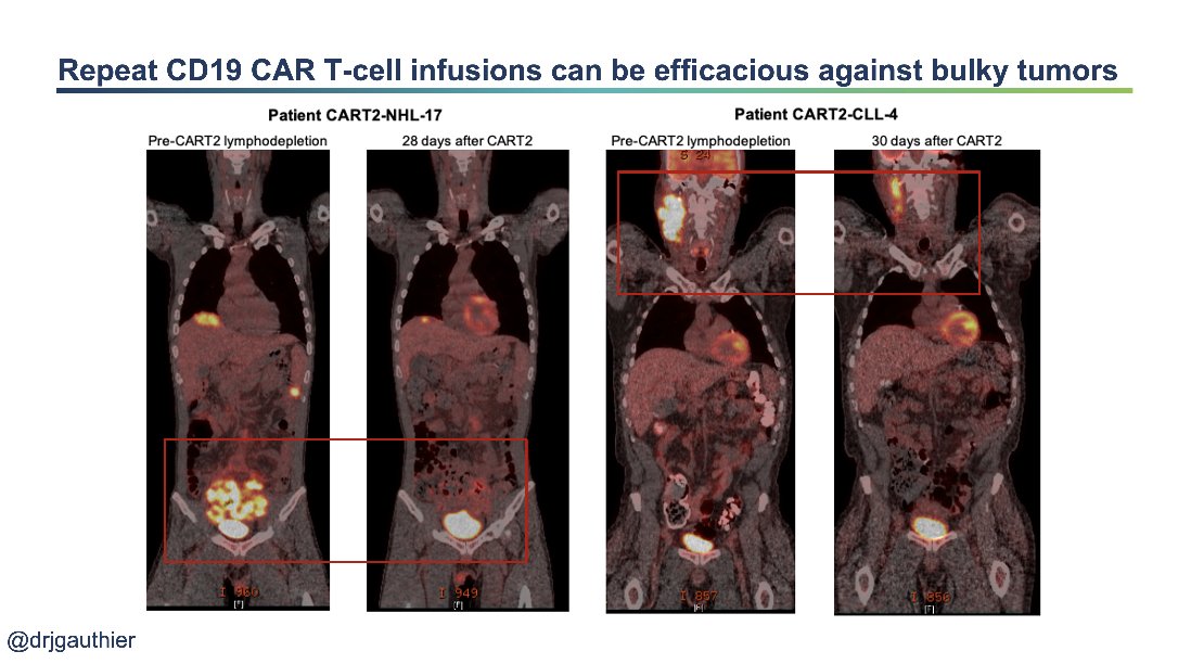 Did it work?The efficacy was lower than what is seen after first infusions (ORR, 39%), but we did observe CRs in a subset of patients (20%), with higher response rates in CLL and NHL patients compared to ALL.Some significant responses in some patients with bulky disease! 10/24