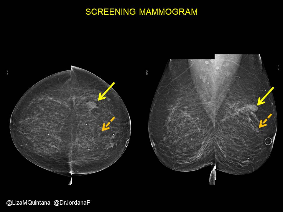 LizaMQuintana's tweet photo. #BreastRadPath case 9 with @DrJordanaP
70ish year old woman. Here is the screening mammo. There are TWO findings!
@BIDMCpath @BIDMC_BreastImg https://t.co/V4VCcf6Cf6