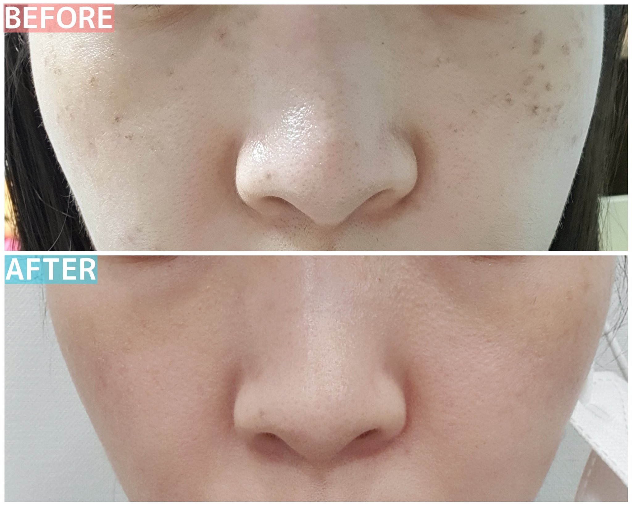 韓国美容 リエンジャン医院 明洞店 リエンジャン明洞店の肌レーザー シミやそばかす 毛穴が気になるならピコ レーザー ピコトーニング シミ トーンアップ ピコ消しゴム そばかす ピコフォーカスモード 毛穴縮小 肌の弾力 韓国整形