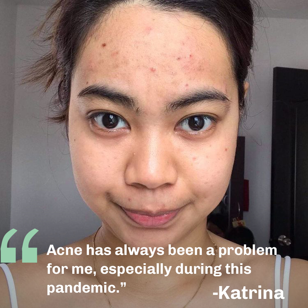 Oxecure_PH's tweet photo. “Acne has always been a problem for me, especially during this pandemic.” Is Katrina’s search for the right acne solution over? 😮 Keep an eye out to see her results when she tried Oxecure! 💚 #OxecureStories #SkinUnfiltered https://t.co/F02equPPKv