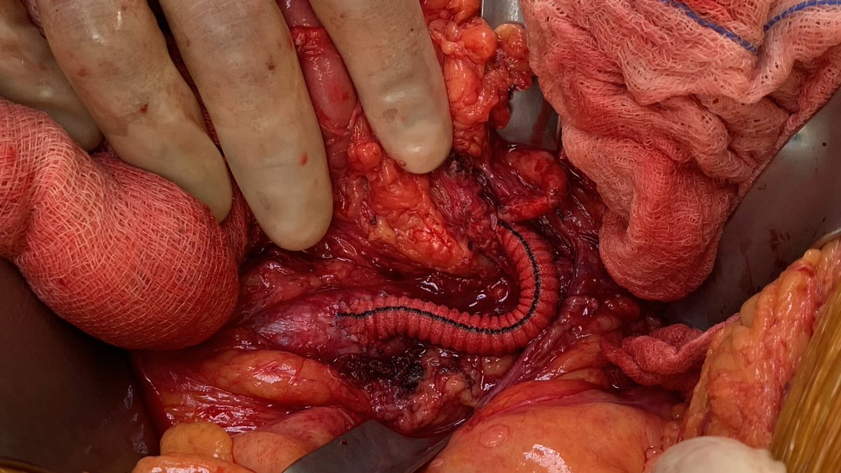 DanielMilesMD (@danielmilesmd) on Twitter photo Patient with chronic mesenteric ischemia with unsuccessful endovascular attempt treated with aorta to SMA bypass (Dacron). Replaced common hepatic from SMA! <a href="/VascSurgLA/">Vascular Surgery Associates</a> <a href="/VascularSurgCS/">Cedars-Sinai Division of Vascular Surgery</a> <a href="/DeptSurgeryCS/">Department of Surgery at Cedars-Sinai</a> #vascularsurgery #SoMe4Surgery #MedEd Patient with chronic mesenteric ischemia with unsuccessful endovascular attempt treated with aorta to SMA bypass (Dacron). Replaced common hepatic from SMA! <a href="/VascSurgLA/">Vascular Surgery Associates</a> <a href="/VascularSurgCS/">Cedars-Sinai Division of Vascular Surgery</a> <a href="/DeptSurgeryCS/">Department of Surgery at Cedars-Sinai</a> #vascularsurgery #SoMe4Surgery #MedEd