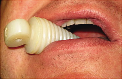 While it may look similar to other devices , this is known as an oral screw and was designed to open a patient's mouth during a seizure because we thought they might swallow their tongue.(A  by  @CatherineCounts)