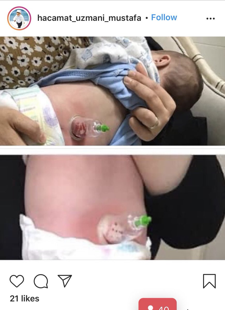 brainsciencetr's tweet photo. İstanbul’un göbeğinde Küçücük çocuklara hacamat adı altında eziyet edilerek İntagram’da paylaşılabiliyor.
Geleneksel Tıp diye müphem bir şeye kapı aralayınca insanımız böyle istismarcıların kuca��ına itiliyor.
Bu Kişi ve çocukların ailelerine fiziksel istismardan işlem yapılmalı https://t.co/fjOlN4BwtI