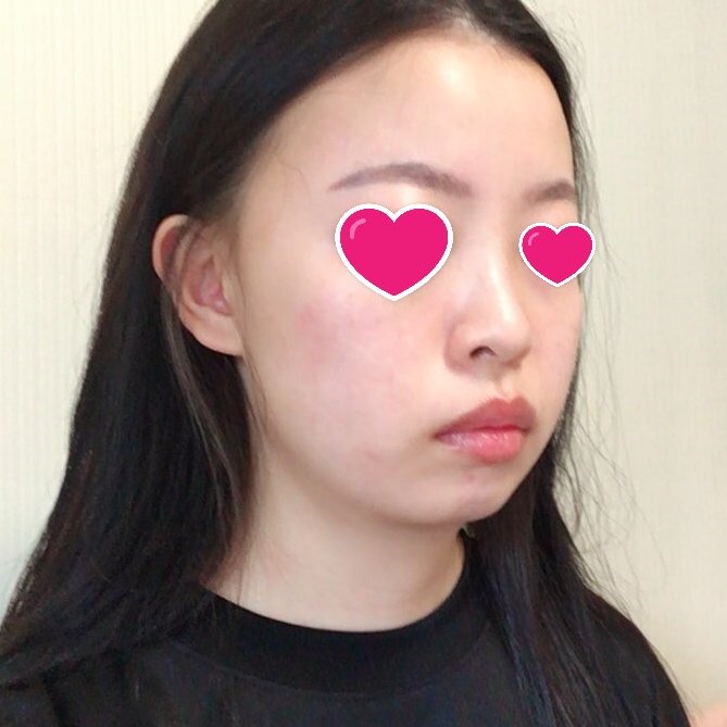 顎なし改善 顎なし改善