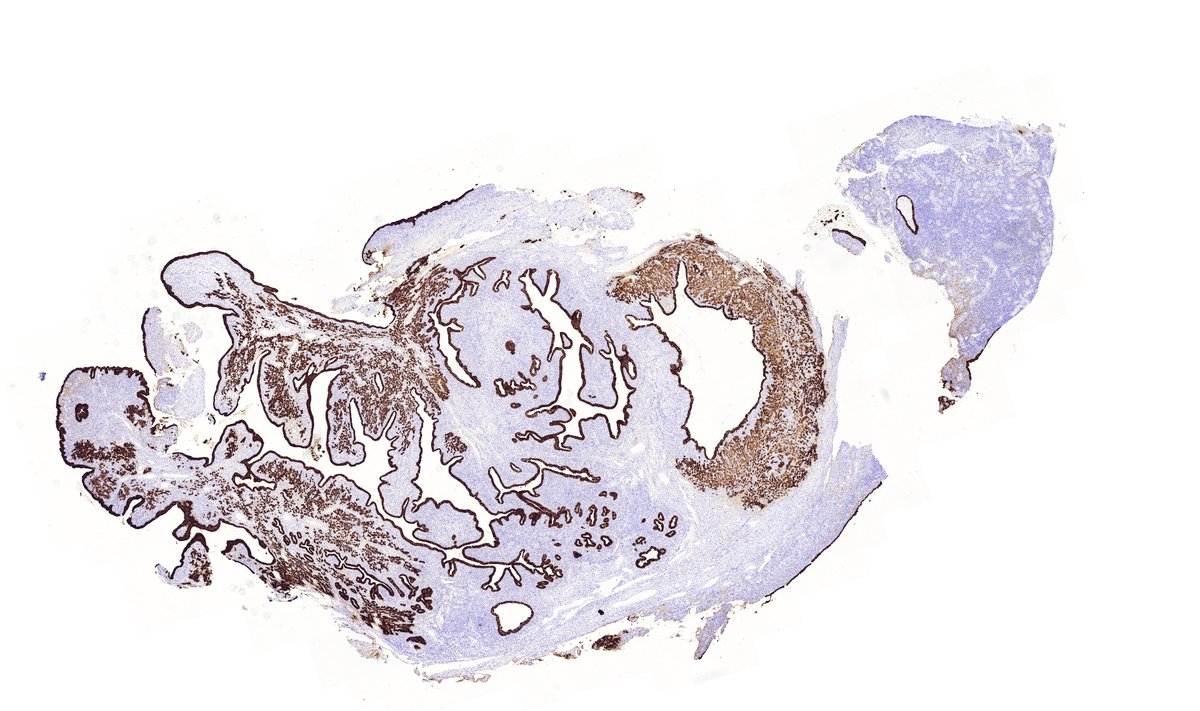 Pancytokeratin