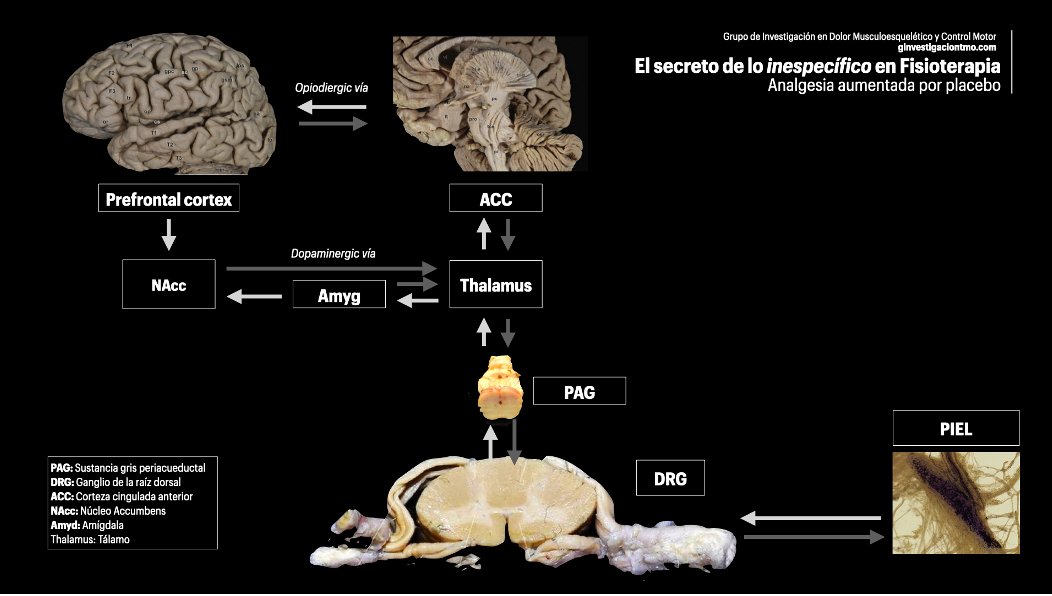 terapiamanualUE's tweet photo. #BlogTMO EL “SECRETO” DE LO INESPECíFICO EN FISIOTERAPIA. ANALGESIA AUMENTADA POR PLACEBO
Nuestro compañero @smartipPT explica de forma brillante el fenómeno de la analgesia aumenta por placebo
@terapiamanualUE
https://t.co/eYnhbyqGol https://t.co/dkT6ipqzMC