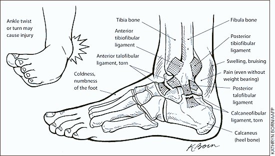 Ankle sprainsAN Educational THREAD