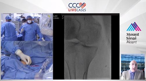 ccclivecases's tweet photo. "Transpedal approach for SFA CTO Intervention"
Send us your questions LIVE NOW to our expert faculty: https://t.co/lLZG6WvdPN
@PK_MountSinai
#ccclivecases #endovascular #perpheral #SFA #CTO #intervention #cardiology #interventionalcardiology #mountsinaihospital #mountsinai https://t.co/J7OTmfLmFg