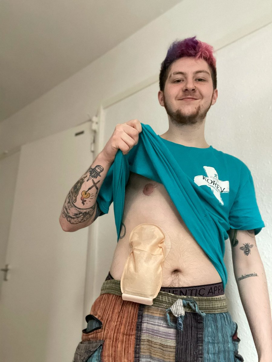 Today, myself and 50 others, including many from the nursing cohort, are wearing a stoma bag for the day filled with cold porridge. This is to simulate just a fraction of what is experienced by those who require a stoma bag for more than just the one day that we are wearing one.