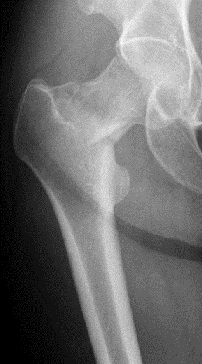 11 days ltr, pt returns to ER w/severe pain in (R) hip. What is the Dx? Pt has a displaced femoral neck Fx. She likely had a femoral neck stress Fx, which would have been Dx'd w/MRI. Once the Fx has completed, the course of Tx & Px change dramatically. What would you do now?