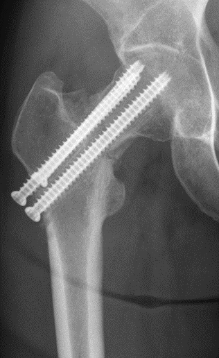 8 wk follow-up xrays. Pt has persistent pain in the hip. What do you see? Is the fracture healing?