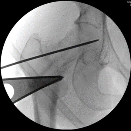 Intra-op fluoro imaging showing a 20 degree lateral closing wedge  #osteotomy Both planning and performing the procedure take several hours. The procedure converts shear forces across the femoral neck nonunion into compressive forces, thus facilitating healing.