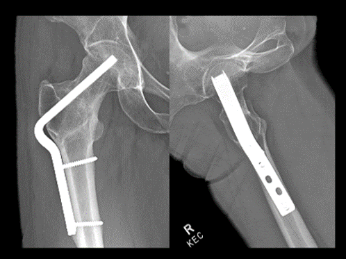 1 yr follow-up xrays. Both the femoral neck nonunion & the  #osteotomy were healed by 3 mos. Pt has returned to all activities & has no painThis operation, although originally described by Pauwels almost 100 yrs ago, is just as relevant & elegant today!Case by: Dr. Tim Achor