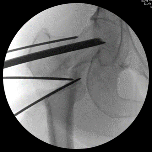 The wedge of bone has been removed, and the chisel for the blade plate has been inserted, both in accordance with the pre-op plan 