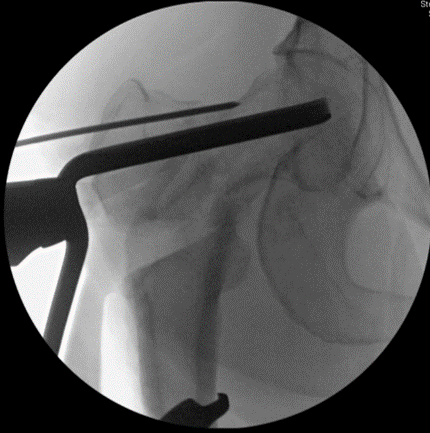The plate is inserted. Notice the wire above the plate- this is to ensure no rotatory  #malalignment is created after the  #osteotomy