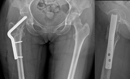 Post-op xrays after the procedure. The overall alignment of the hip has been restored. The patient is given crutches and toe-touch restrictions for 6 weeks  #postop  #traumacase  #orthopaedics