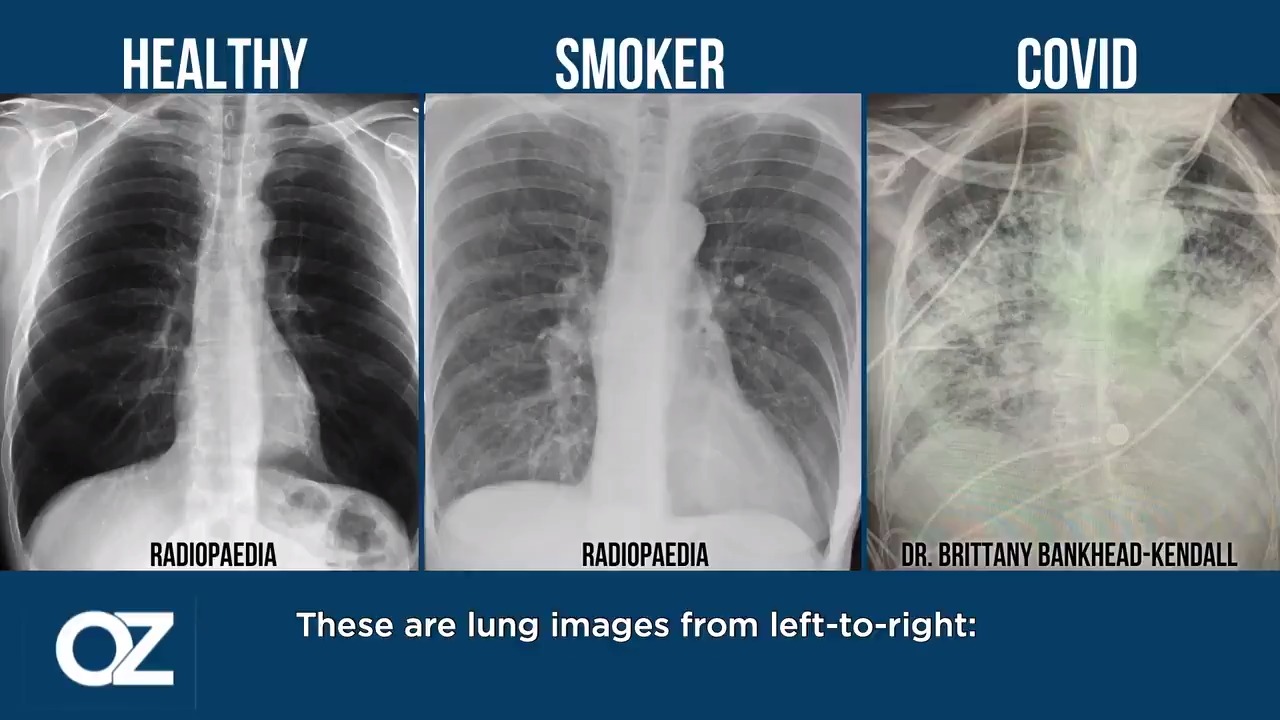 Chest X Ray Smoker Vs Nonsmoker