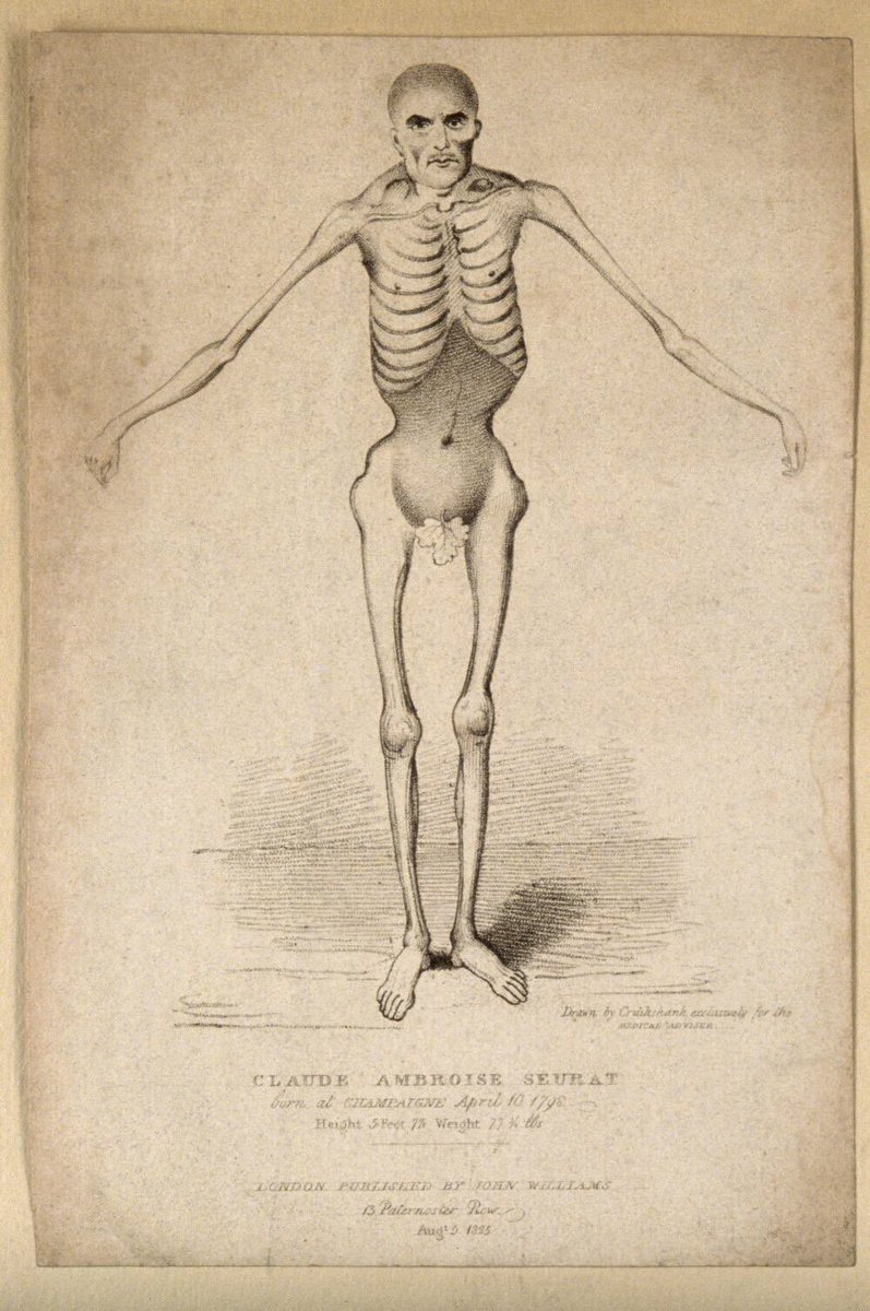 It seems that Claude’s problem was swallowing - dysphasia - leading to him eating awoefully inadequate intake of food, generally nothing more than a bread roll and a bit of wine each day. This drawing of him is by Robert Cruikshank from during his time in England (Wellcome)