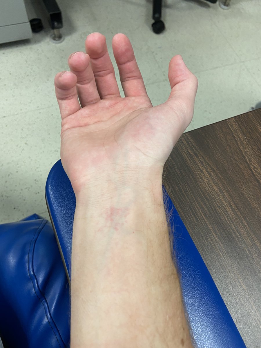 Seconds later my wrist got VERY itchy. I have to seriously fight the urge to scratch as the itching continued for ~30 mins before fading. Here is what my arm looked as soon as the patch was taken off an hour later