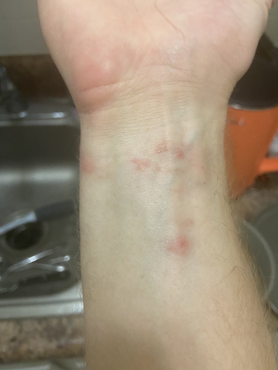 Blood works shows I have eosinophilia as my immune system kicks into high alert for parasites. After 10 days the rash returns with a vengeance! This was expected. Most infected people have an initial rash that fades, then it returns even worse before fading over the next month
