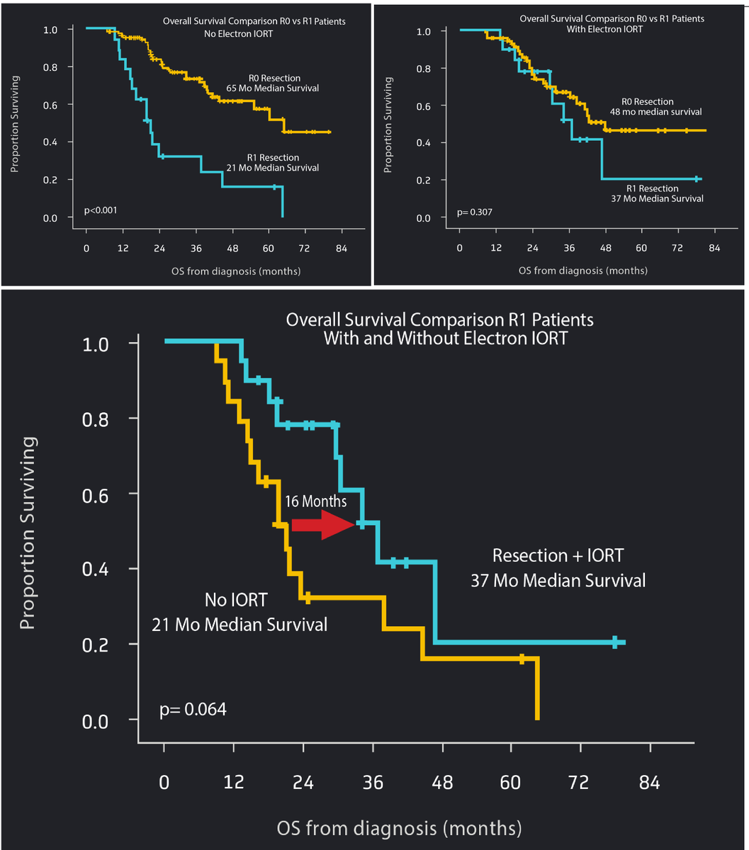 IntraOp_Medical's tweet photo. New Research indicates electron beam IORT may mitigate the adverse effect of R1 resections for borderline and locally advanced pancreatic cancer patients in terms of Disease Free and Overall Survival. 

Read the study: https://t.co/LyF9sCHiHZ https://t.co/3UCuvT7VMJ