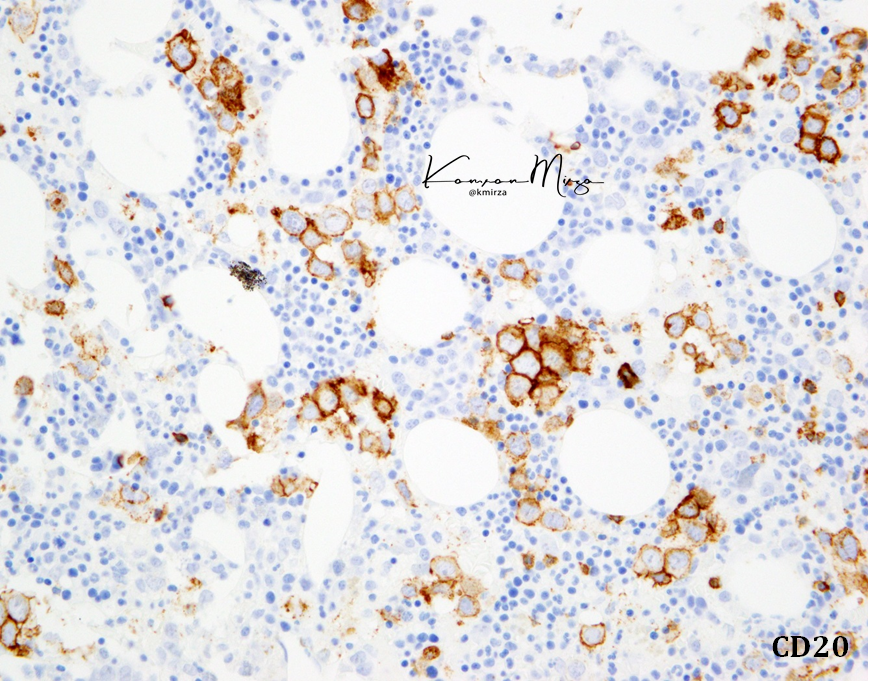 What can we glean from the pattern of #bonemarrow involvement by #BcellLymphoma? This middle-aged patient presented with features of HLH and a B cell lymphoma was diagnosed in the marrow - What pattern is this? #lymsm #hemepath - see paper below.