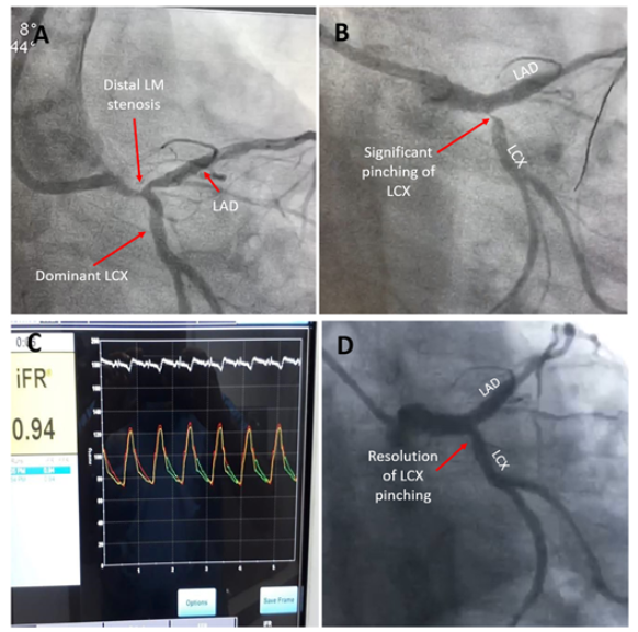GreggWStone's tweet photo. Final poll results: 45% PCI, 30% no Rx, 25% want more info. Equipoise! Here's what happened (Gupta &amp; Chhikara, EHJ). They left it, pt remained stable, routine FU at 6 mo showed resolution of  the angio lesion. We  need a large study to determine if this is the right approach. https://t.co/fM7RWBFK5M