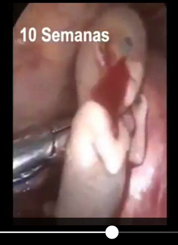 Gery46665341's tweet photo. EL DERECHO A LA VIDA NO SE DISCUTE, SE DEFIENDE - No a la ley de aborto chilena.
#DestitucionDeOrsini

@CNNChile @meganoticiascl @24HorasChile @24ChileNoticias @CHVNoticiascl @T13 @MatinaldeCHV @MuchoGustoMEGA https://t.co/o9Jqj523Ck