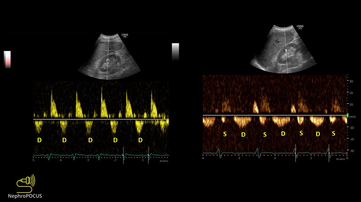 #POCUS #VExUS image of the day:
Renal decongestion: Transformation of the renal parenchymal vein waveform with diuretic therapy (approximately 4L net negative)
#diuresisjedi #MedEd
